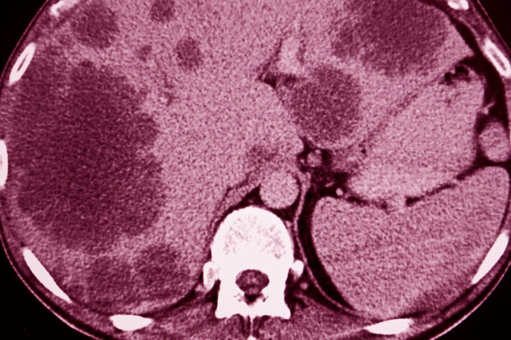 CAR-T cell therapy solid tumors